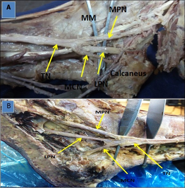 Photographs of the ankle region in (A) and (B)                  showing a single medial calcaneal nerve (MCN) originating from the tibial nerve (TN) deep in the tarsal tunnel.