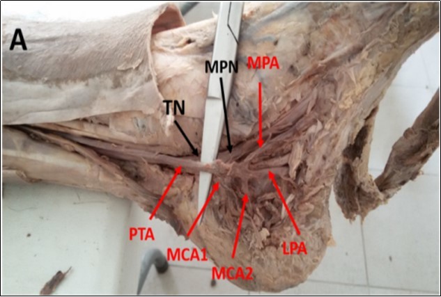 Photograph of the left ankle region showing double              medial calcaneal arteries (MCAs) branching from the posterior   tibial artery (PTA). MPA: Medial plantar artery, LPA: lateral plantar artery, TN: tibial nerve, MPN: medial plantar nerve.