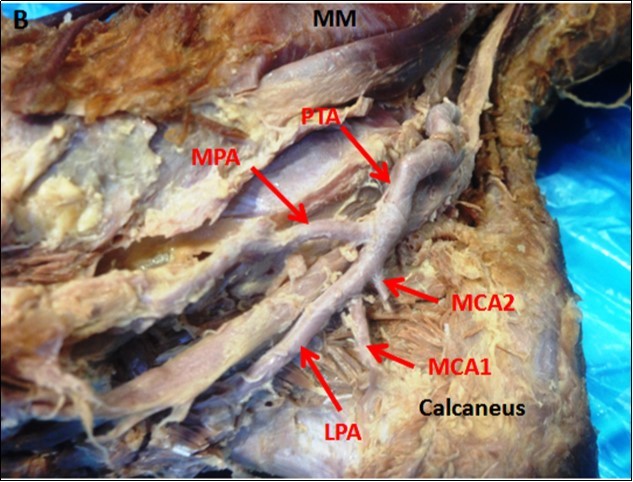 Photograph of the right ankle region (B) showing double medial calcaneal arteries (MCAs) branching from the lateral plantar artery (LPA). PTA: Posterior tibial artery, MPA: medial plantar artery, MM: medial malleolus.