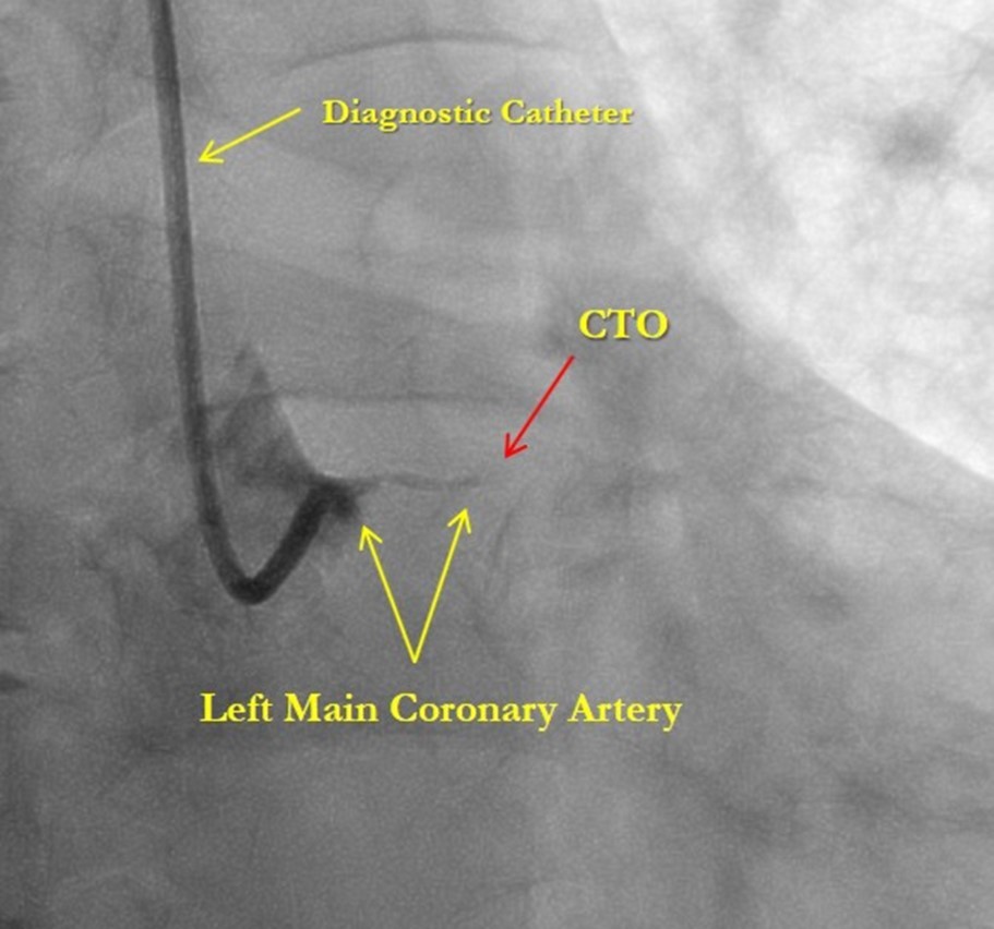 Chronic total occlusion of the left main coronary artery