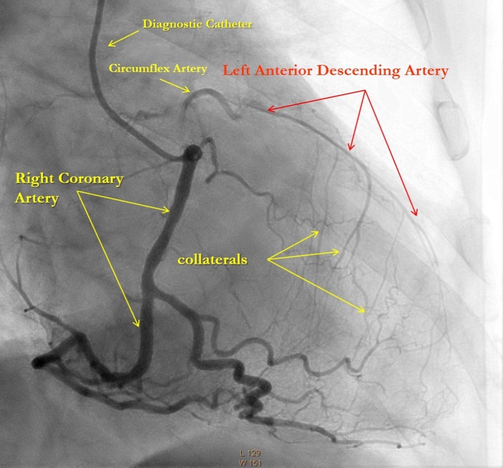 Right Coronary Artery with developed right-to-left collaterals.