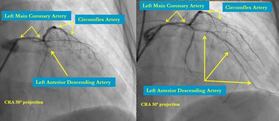 LMCA, CX, LAD after recanalization and predilatation