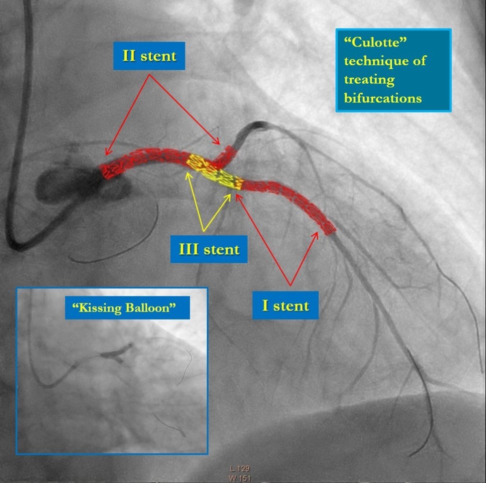 Culotte stenting technique