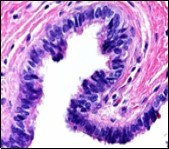 Ciliated cutaneous cyst lined by pseudostratified ciliated columnar epithelium and a                 supporting fibro-connective tissue stroma 11.