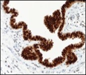 Cutaneous ciliated cyst with nuclear immune               reactivity to progesterone                receptors (18).