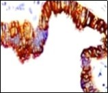 Cutaneous ciliated cyst with immune reactivity to cyto-keratin (19).