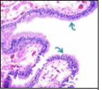 Ciliated cutaneous cyst with an undulating layer of               ciliated cuboidal epithelium  and supporting fibrous tissue                framework (12).