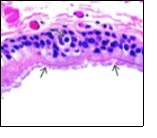 Ciliated cutaneous cyst with a coating of plump, ciliated columnar epithelium  and a                 circumscribing fibro - connective tissue (12).