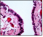 Cutaneous ciliated cyst with a ciliated, pseudostratified columnar epithelium and                vascularized fibrous tissue                   stroma (13).