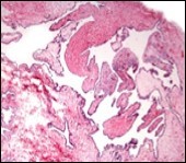 Cutaneous ciliated cyst with incomplete intervening septa  and a lining of attenuated, ciliated epithelium along with supporting fibrous tissue (13).