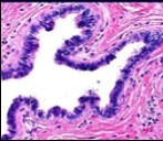 Cutaneous ciliated cyst with a ciliated cuboidal lining,     undulations within the cyst cavity and a wall comprised of                   fibro-connective tissue (14).