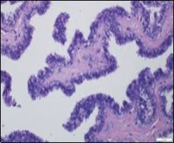 Cutaneous ciliated cyst with  papillary structures,  a               coating of ciliated columnar                 epithelium supported by a                  connective tissue framework (15).