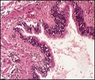 Cutaneous ciliated cyst with incomplete septa and a layer of pseudostratified, ciliated                   columnar epithelium surrounded by fibrous tissue (16).