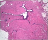 Cutaneous ciliated cyst with abundant, circumscribing         fibro-connective tissue and a cyst lined by ciliated columnar epithelium (17).