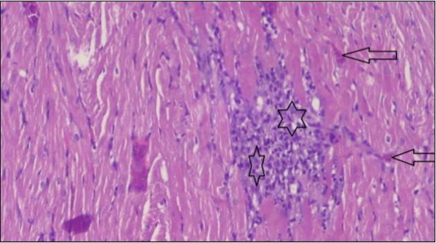 Photomicrograph of heart section of  an obese rat showing large number of inflammatory cells (star), degeneration               muscles fiber, circle and congested Blood vessels (arrow), (H&E) (400X).