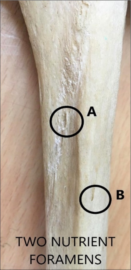 showing two nutrient foramina on shaft of tibia