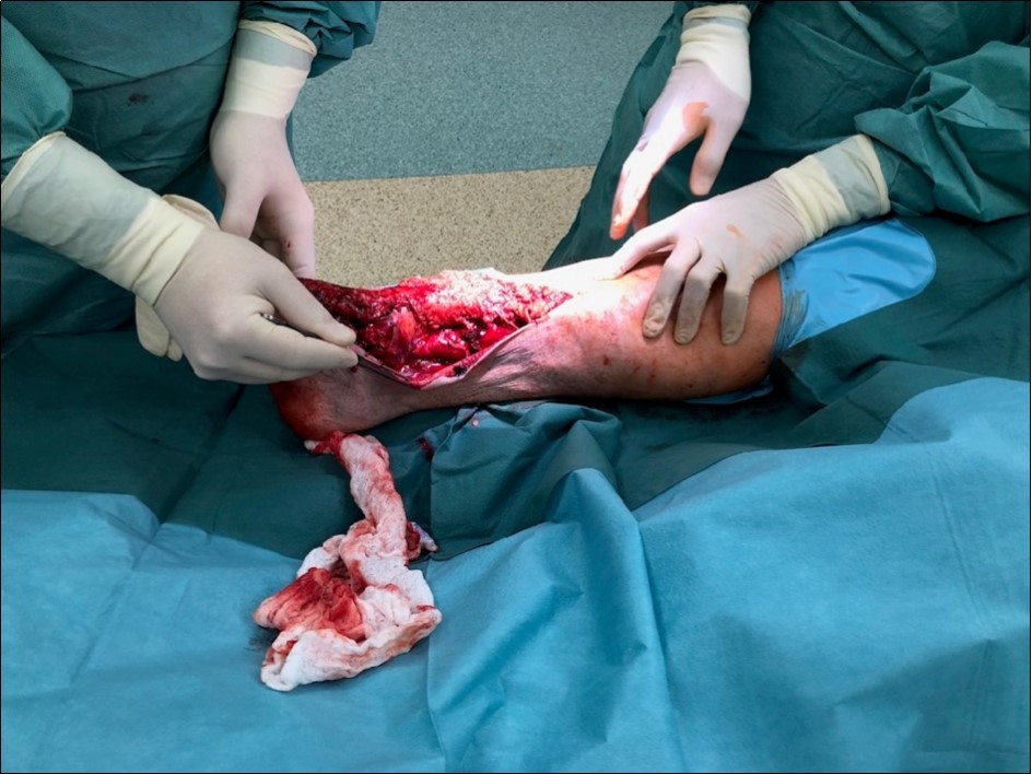 22 January – primary surgical treatment in the operating room