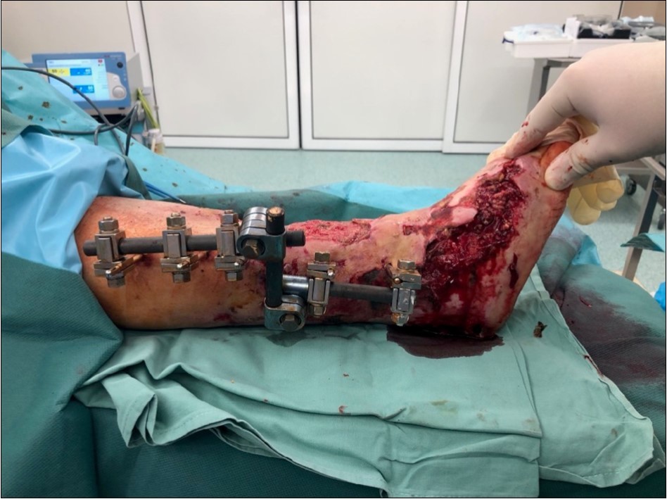 19 February. performed necrectomy, vitalization of subcutis, application negative pressure wound therapy