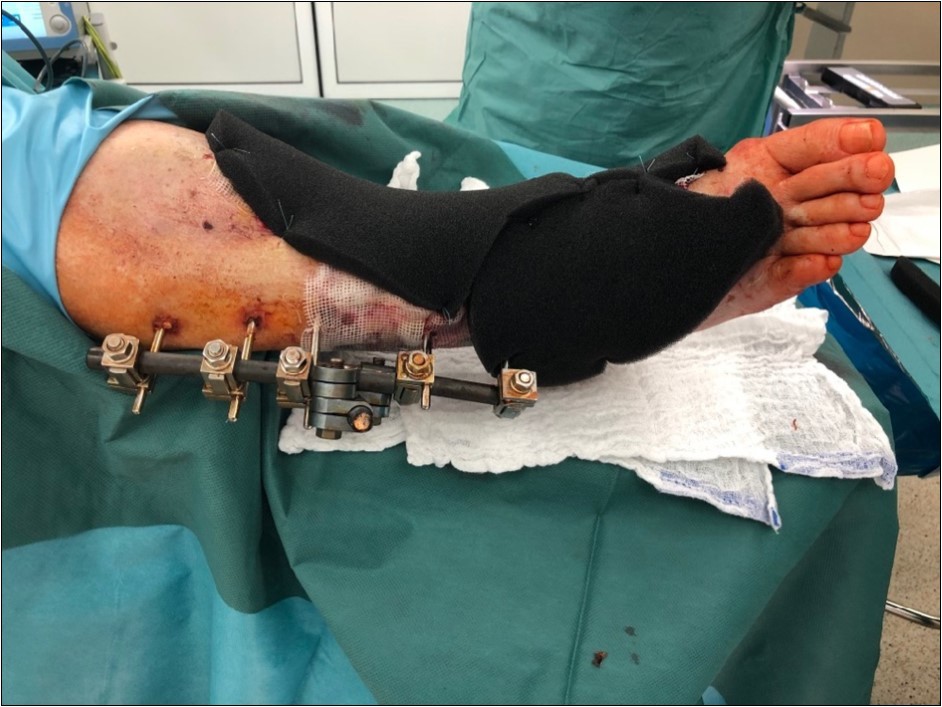 19 February. application of negative pressure wound therapy Vivano. application of polyurethane foam, foil, central port with tubing