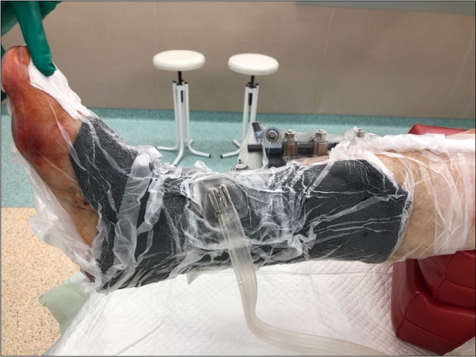 19 February. application of negative pressure wound therapy Vivano. application of polyurethane foam, foil, central port with tubing