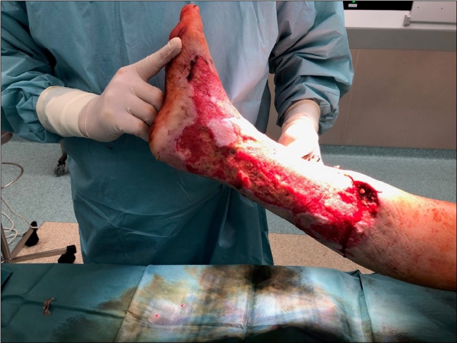 19 March. Defect of limb already clean with granulation ready for application of dermoepidermal graft