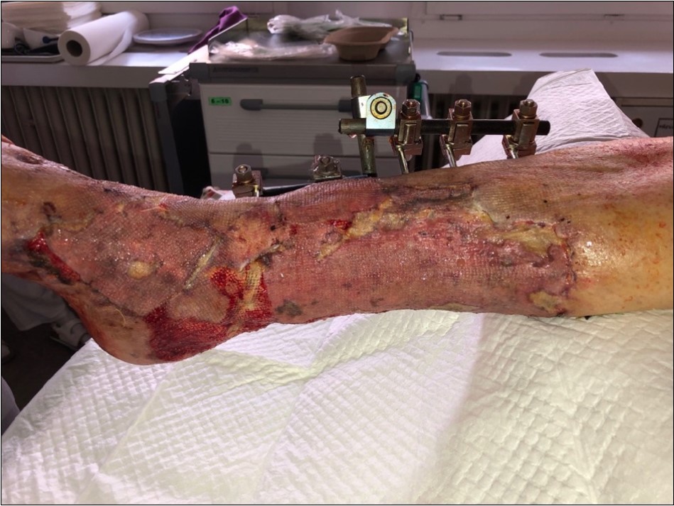 after removing the therapy. dermoepidermal graft successfully fixed