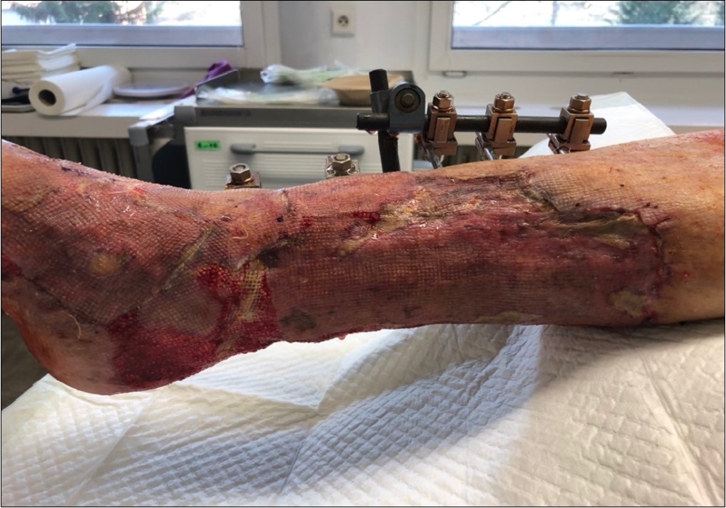 after removing the therapy. dermoepidermal graft successfully fixed