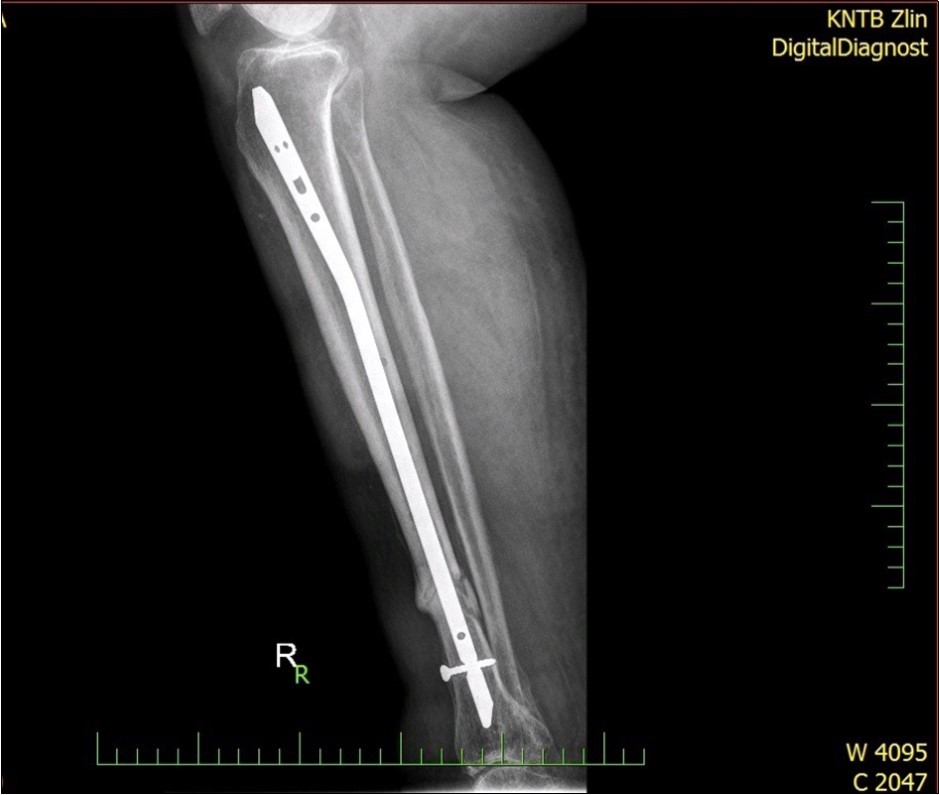 23 April. Surgery conversion of osteosynthesis. Removal external fixator and implantation intramedullary tibial nail. Gradual bone healing - last X-ray september 2019