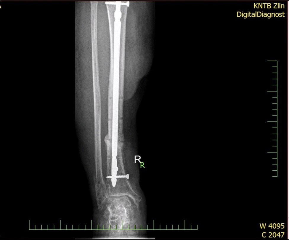 23 April. Surgery conversion of osteosynthesis. Removal external fixator and implantation intramedullary tibial nail. Gradual bone healing - last X-ray september 2019