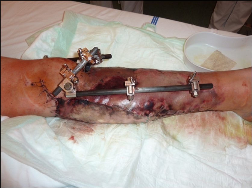 After 2 weeks. Progression of the skin necrosis line demarcation