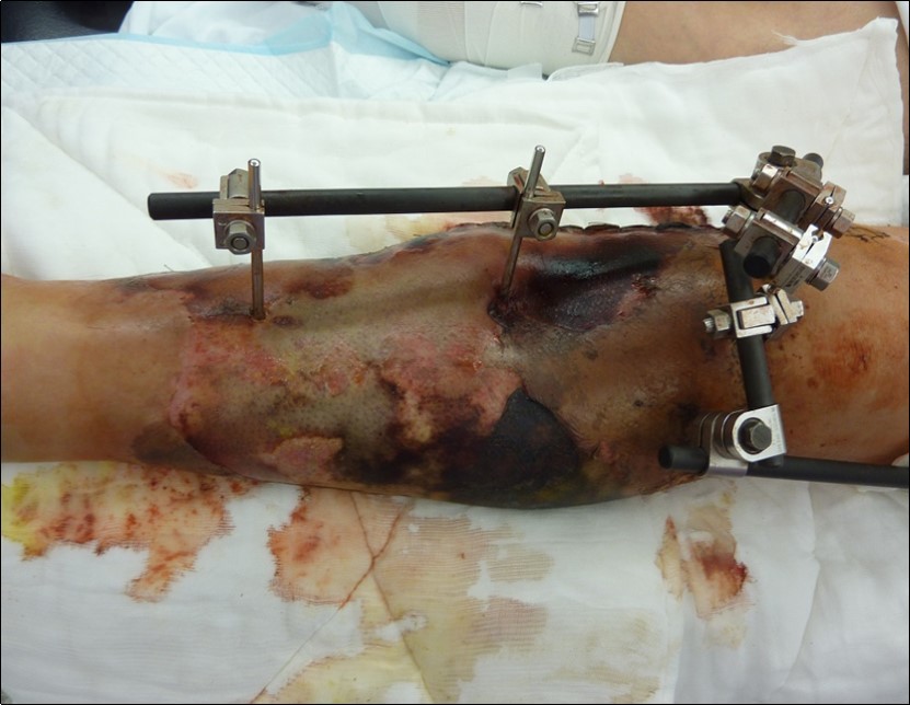 After 2 weeks. Progression of the skin necrosis line demarcation