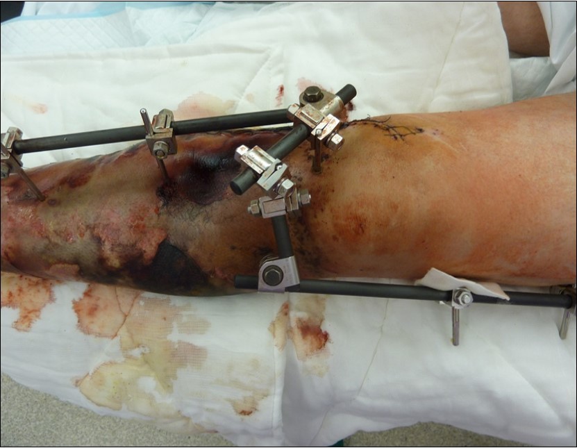 After 2 weeks. Progression of the skin necrosis line demarcation