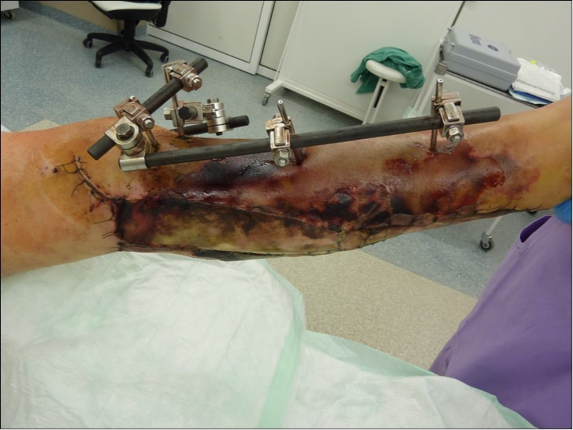 After 2 weeks. Progression of the skin necrosis line demarcation