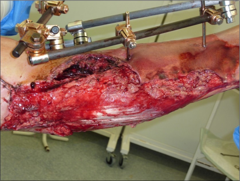 After 3 weeks performed necrectomy, vitalization of subcutis, application negative pressure wound therapy