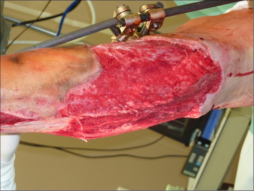 Dressing changing negative pressure woud therapy after 7 weeks. advanced granulation suitable for application of dermoepidermal graft