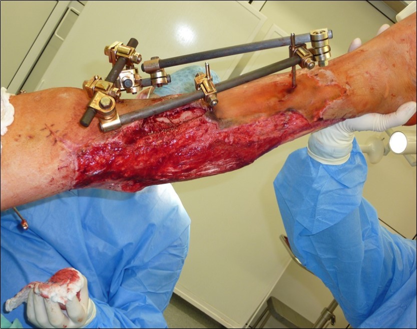 Dressing changing negative pressure woud therapy after 7 weeks. advanced granulation suitable for application of dermoepidermal graft