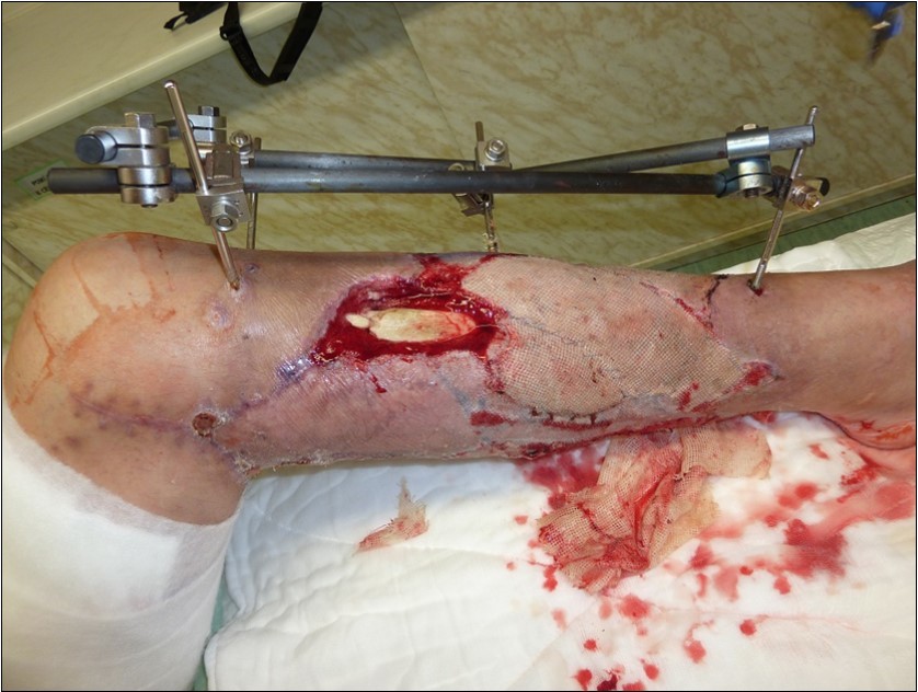 Application of dermoepidermal graft in individual steps from December 2015 to January 2016. use of vacuum therapy with good graft fixation and graft drainage