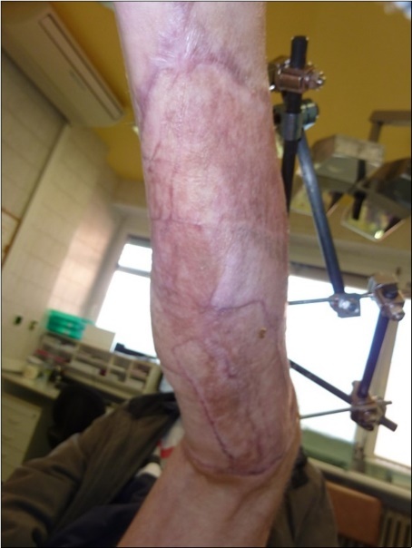 Skin cover completely healed. 9 months from the injury to heal soft tissues