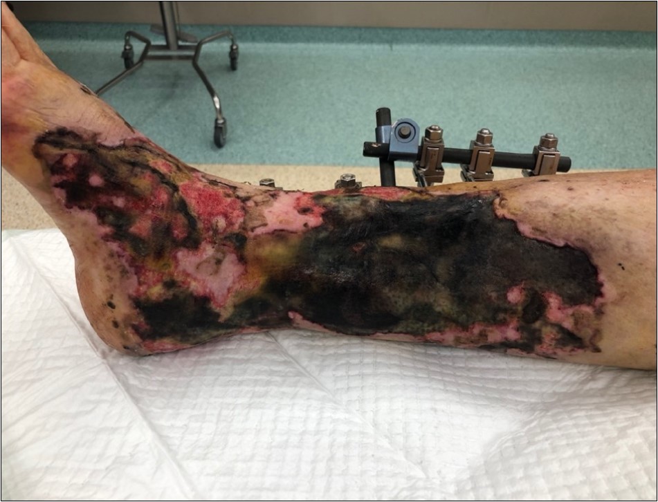 9 February. Extensive necrosis of skin and subcutis in the area of primary limb laceration. Progression of the skin necrosis line demarcation
