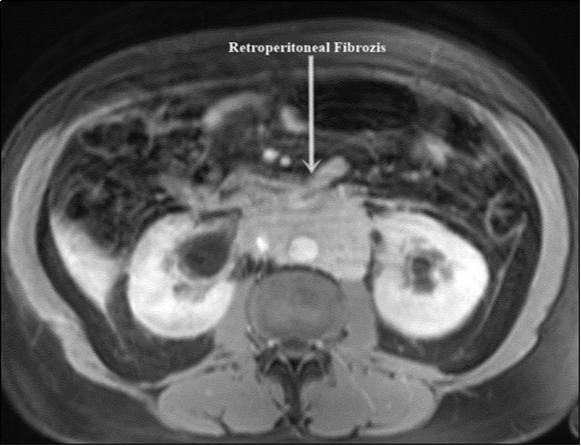 Retroperitoneal fibrosis involving both ureters.