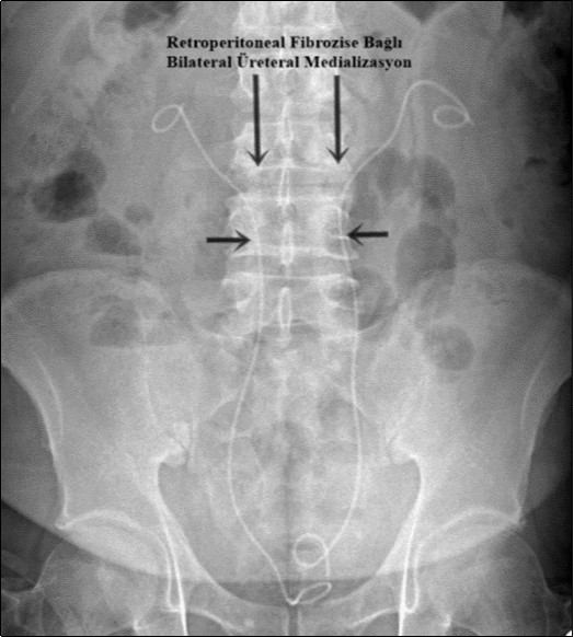 Ureteral diversion with bilateral double-J catheter. Both ureters were pulled medially due to retroperitoneal fibrosis.