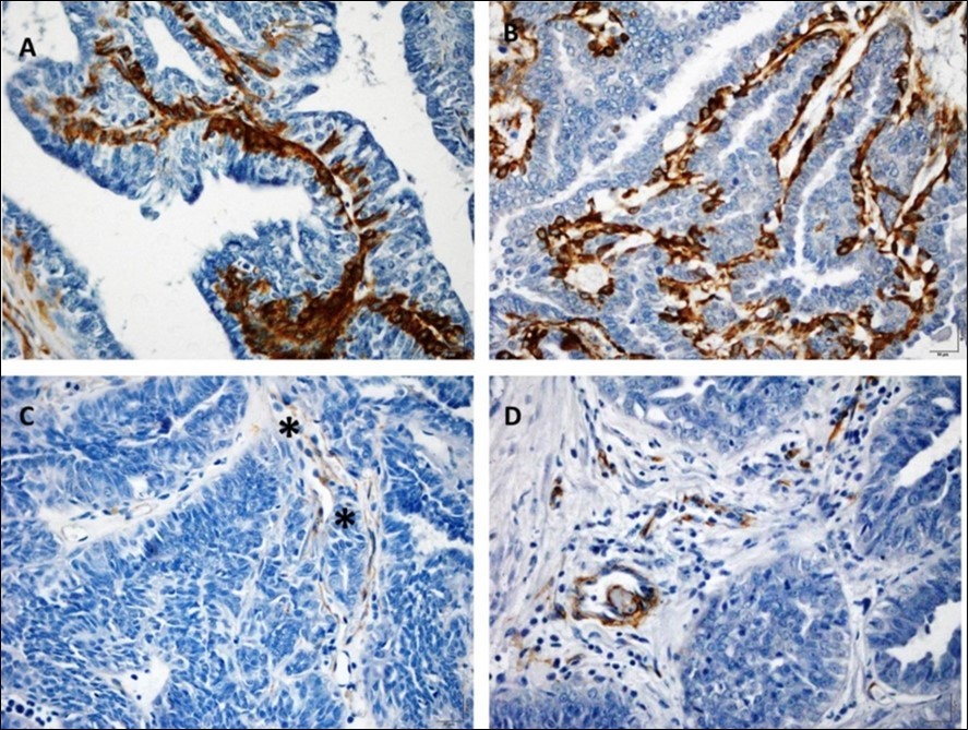 Photomicrographs of papillary tumors in mammary gland of female dogs. (A)          Papillary tumor with intense positive marking for the α-SMA within the papillae (bar = 10 μm). (B) Positive to moderate positive papillary tumor for α-SMA (bar = 10 μm). Papillary tumors with reduced (C) or scarce immunolabeling (*) (D) for the same antibody (bar = 10 μm). All samples were classified by HE analysis as papillary carcinoma. Complex of Peroxidase bound polymers.