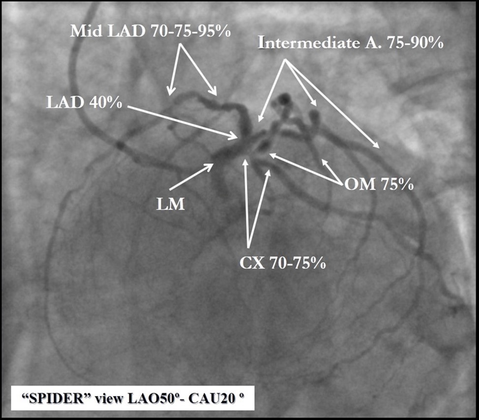 Quadrifurcation of the left main coronary artery