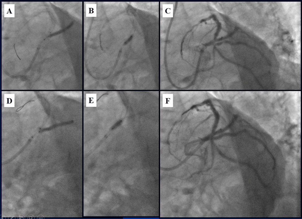 Stenting of the LMCA quadrifurcation: A, B - balloon modified mini crush stenting of the IMA, C - angiography result, D,E - modified balloon crush stenting of the CX-OM1, F - angiography result.