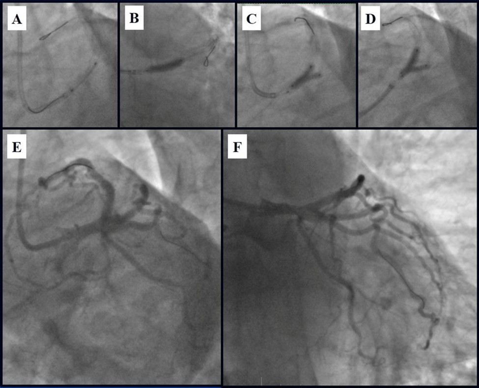 Stenting of the LMCA quadrifurcation: A, B – Stenting of the LMCA; C –Kissing balloon post dilatation of the IMA-LMCA-LAD; D - Kissing balloon post dilatation of the CX-OM1-LMCA; E,                             F - angiography result.