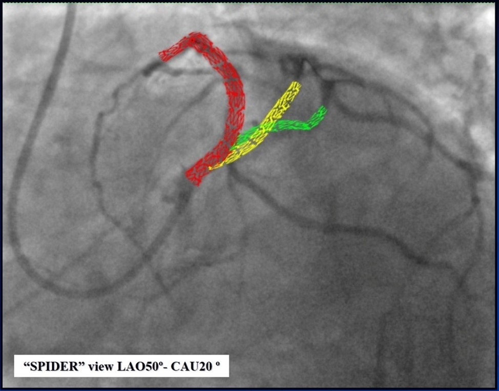 Schematic presentation of the implanted stents, “spider” projection.