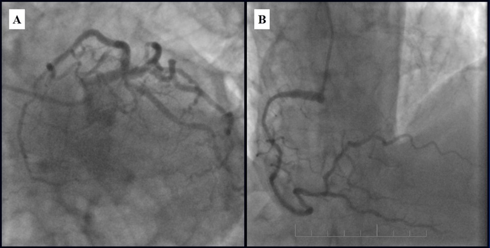 Subsequent  CAG eight months after last PCI; A - Patent stents with mild, non-significant restenosis in left coronary artery; B - 50-60% in-stent restenosis in RCA.
