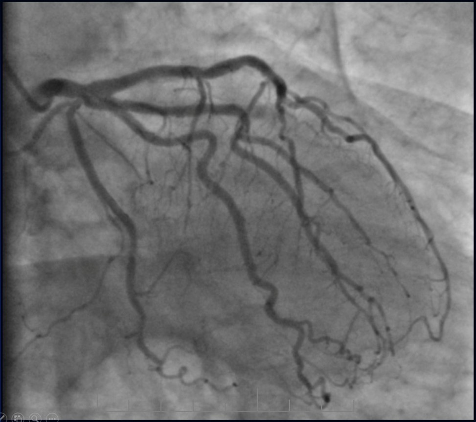 Left coronary artery, follow-up CAG eight months after last PCI.