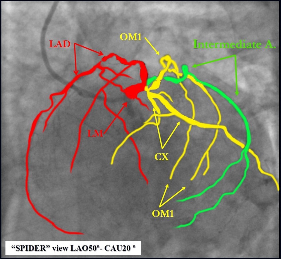Schematic presentation of the left main quadrifurcation.
