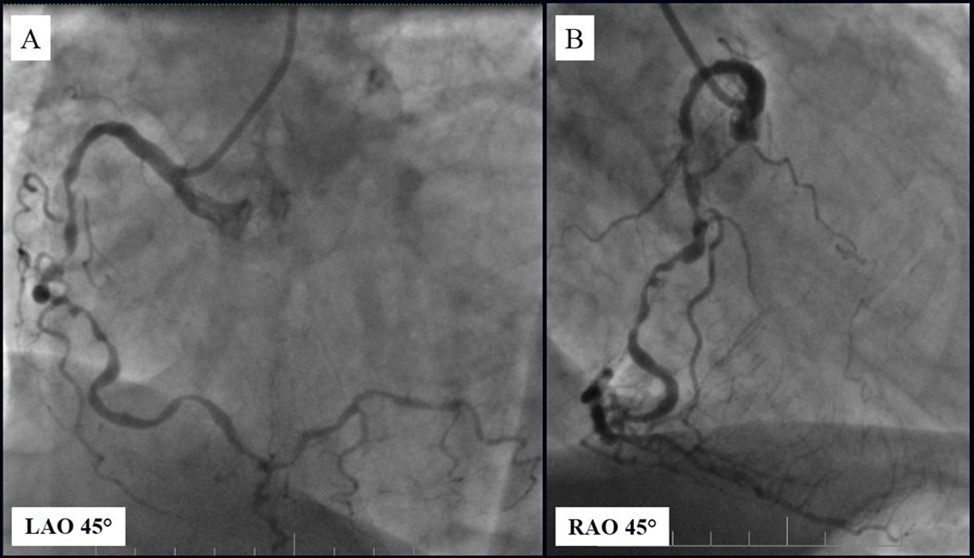 Prolonged diffuse severe 90-95% stenosis of mid-segment of the right coronary artery.               A - Left anterior oblique 45° projection; B – Right anterior oblique 45° projection.